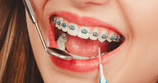 Innovative Approaches to Painless Braces Exploring New Technologies